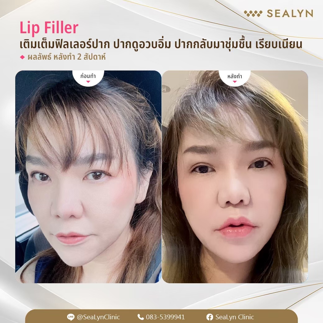 ฟิลเลอร์ ปาก